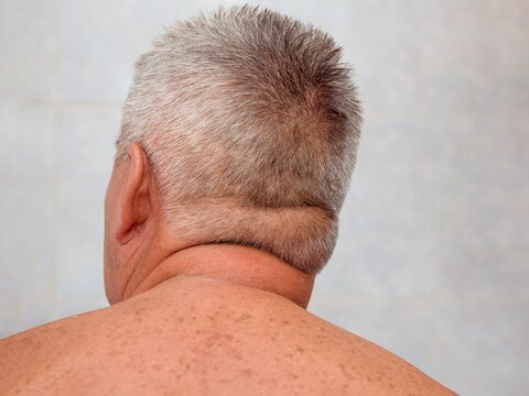 A close-up of a man's back of the head and neck, showing a visible subcutaneous lipoma on the scalp