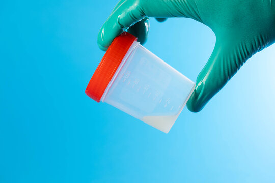A urologist's hand holding a container of prostate fluid against a blue background. Conceptual illustration of prostate fluid microscopy, detecting leukocytes