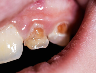 Close-up of human oral cavity showing severe enamel hypoplasia and tooth decay due to sweet food consumption, exposed dentin, inflamed gum area