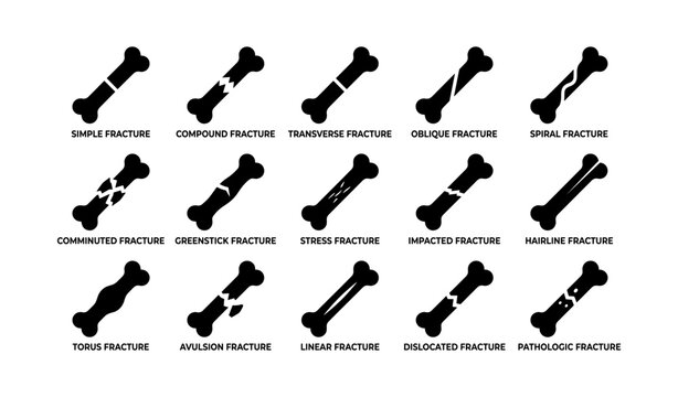 Types of bone fractures: simple, compound, transverse, oblique, spiral, comminuted, greenstick, stress, impacted, hairline, torus, avulsion, linear, dislocated, pathologic