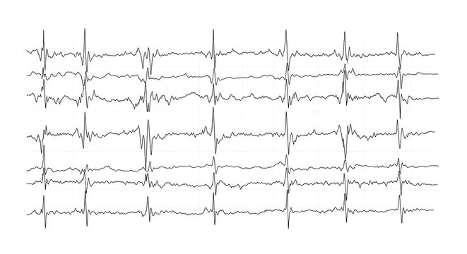 Medical professional analyzing ECG electrocardiogram readings on a screen