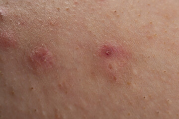 Fototapeta premium Acne on skin closeup photo. Irritated skin with pimples acne texture. Close up epidermis with inflamed follicles and acne. Detailed skin with acne.