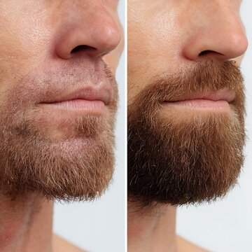 before and after shaving damage repair, macro beard area skin comparison, irritated textured skin on left, healthier smoother skin on right, short beard stubble visible