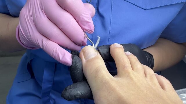 Podologist puts a tomponade under the nail. Podological pedicure. Pedicure master makes podological pedicure