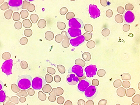 Acute leukemia. WBC is grossly increased in number, left shift, atypical looking large mononuclear cells.