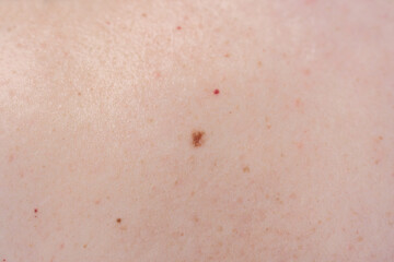 A mole on the body in close-up, the concept of dermatology