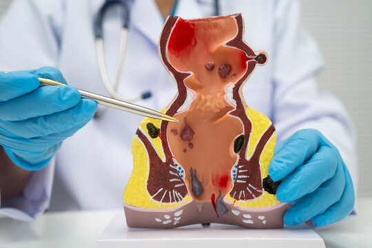 Asian doctor with rectum and hemorrhoid human anatomy model at hospital, inflamed vascular structure.