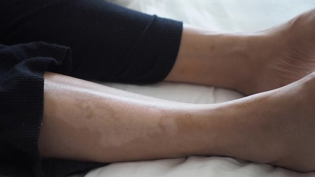 Close up on legs with discoloration, medical skin condition or beauty concern, detailed shot