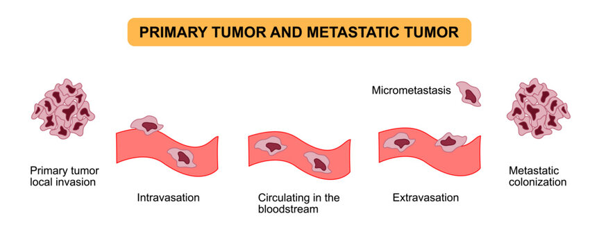Primary tumor and metastatic tumor formation diagram. Tumor cell spread in bloodstream, Intravasation and Extravasation. Vector illustration for medical, science, posters and education.