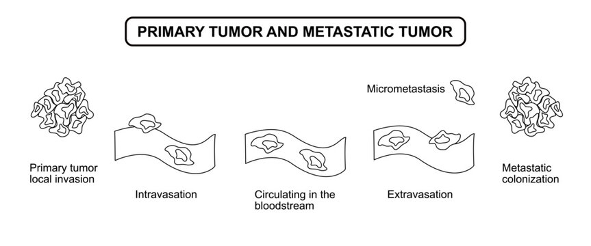Primary tumor and metastatic tumor formation diagram. Tumor cell spread in bloodstream, Intravasation and Extravasation. Vector line drawing illustration for medical, science, posters and education.