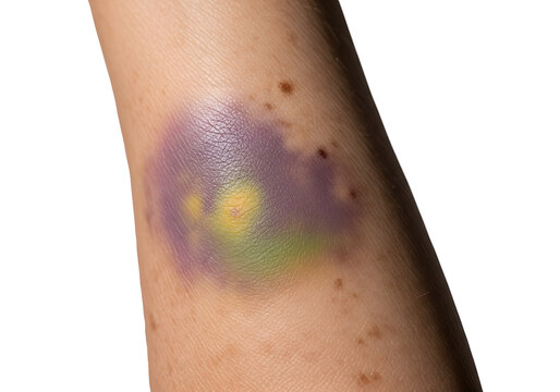 A close-up view of a bruised arm with a large purple and yellow mark, set against a plain white background, conveying a sense of injury or medical condition.