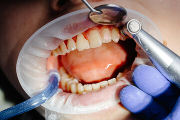 Dentist performing dental checkup cleaning teeth of patient wearing protective glasses