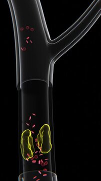 Artery Blockage visualization video in 4K | Vertical Xray video of Artery Blockage