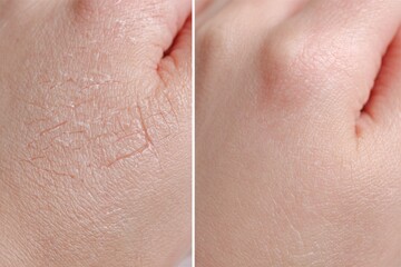 Fototapeta premium Before and after collage of dry cracked skin on hand being treated with moisturizing cream for healthy results