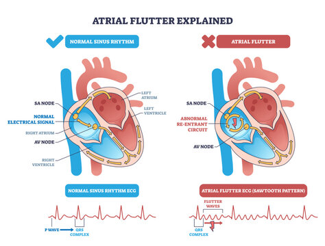 Atrial flutter explained diagram contrasts normal rhythm with re-entrant circuit in the heart, highlighting SA node, AV node, and sawtooth ECG pattern for clarity, transparent background.