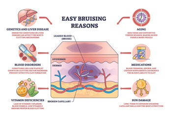 Fototapeta premium Easy bruising reasons diagram illustrates skin layers with broken capillary and leaked blood forming a bruise, key objects, skin cross-section, capillary, bruise, transparent background.