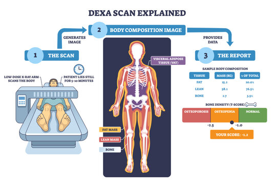 DEXA scan explained illustrates low-dose X-ray imaging yielding body composition and bone density report, key objects, scanner table, human anatomy figure, results chart, transparent background.
