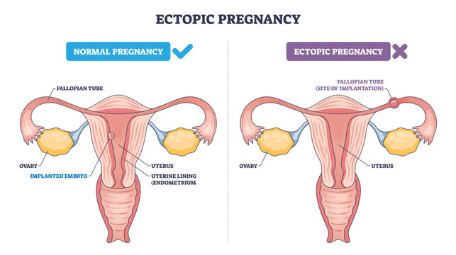 Ectopic pregnancy diagram contrasts normal uterine implantation with a tubal pregnancy, key anatomy, fallopian tube, uterus, embryo placement, transparent background.