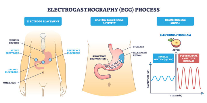 Electrogastrography process diagram shows electrode placement, gastric slow-wave propagation, and EGG waveform, key objects, electrodes, stomach, signal graph, transparent background.