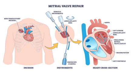 Fototapeta na wymiar Mitral valve repair diagram depicts mini-thoracotomy incision, annuloplasty ring, and heart cross-section, conveying minimally invasive valve reconstruction concept, transparent background.