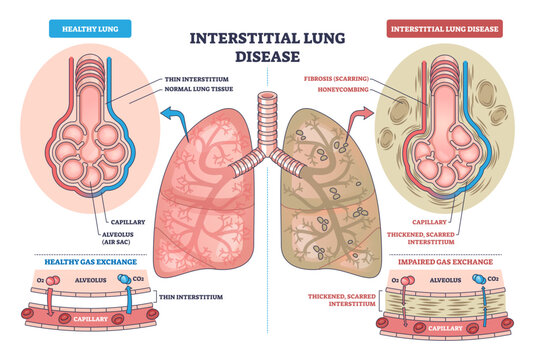 Interstitial lung disease outline contrasts healthy vs fibrotic lungs, showing alveoli thickening and impaired gas exchange, key objects, lungs, alveoli, capillaries, transparent background.