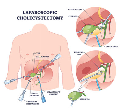 Laparoscopic cholecystectomy explained, instruments insert through small incisions to clip cystic duct and remove the gallbladder, highlights laparoscope, gallbladder, surgical clips.