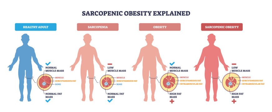 Sarcopenic obesity explained visually, four silhouettes compare muscle loss and fat gain, main objects are body silhouettes, fat-muscle cross-sections, and labels, transparent background.