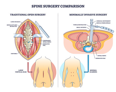 Spine surgery comparison shows open vs minimally invasive methods, highlighting vertebra, herniated disc, and spinal nerve to explain incision and scarring differences, transparent background.