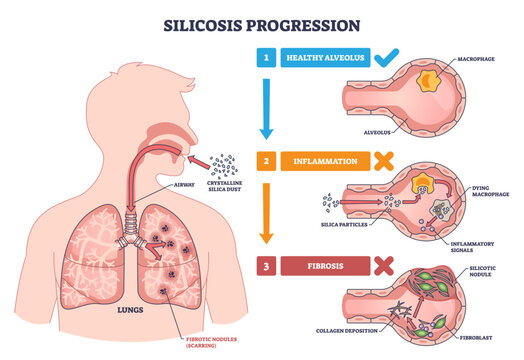 Silicosis progression shows how inhaled silica dust injures alveoli, triggering inflammation and lung fibrosis, key objects, lungs, alveolus, silica particles, transparent background.