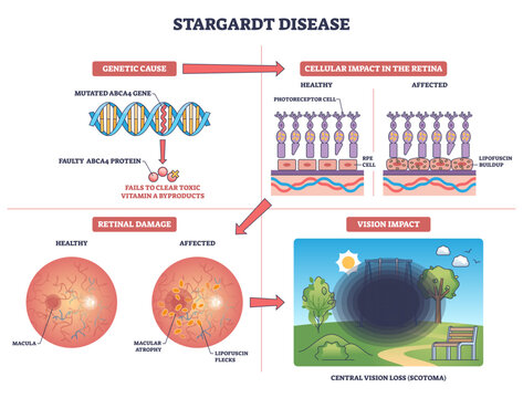 Stargardt disease overview linking ABCA4 mutation to retinal lipofuscin and central vision loss, key objects, ABCA4 gene, photoreceptor cells, macula, transparent background.