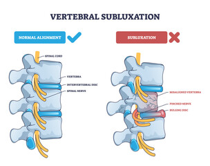Plakat Vertebral subluxation diagram compares normal alignment with misaligned vertebra pinching nerve and bulging disc, key objects, vertebrae, discs, spinal nerves, transparent background.