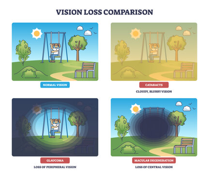 Vision loss diagram compares normal sight, cataracts, glaucoma, macular degeneration using a playground scene with swing, trees, bench, transparent background.
