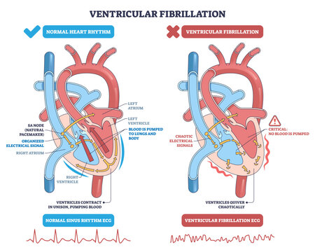 Ventricular fibrillation explained, side-by-side heart diagram contrasts normal rhythm with chaotic quivering, key elements are ventricles, electrical signals, and ECG traces, transparent background.