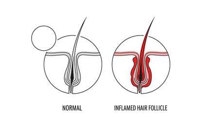Obraz premium Comparison of Normal and Inflamed Hair Follicle Diagrams.