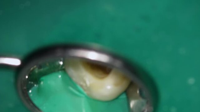 Inspect root canal. Comprehensive inspection of isolated molar canal and chamber structure. Detailed final assessment of shaped root canal within molar using mirror and clamp for documentation