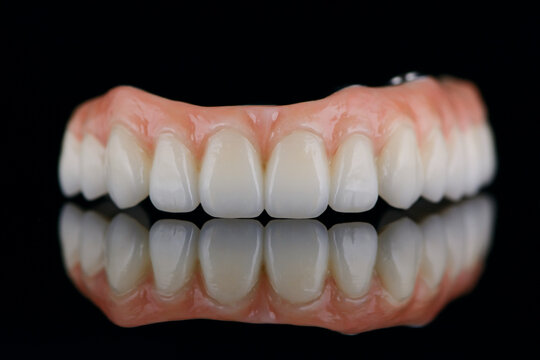 Full dental zirconium prosthesis on titanium bar stained with stains for ceramic. Upper jaw