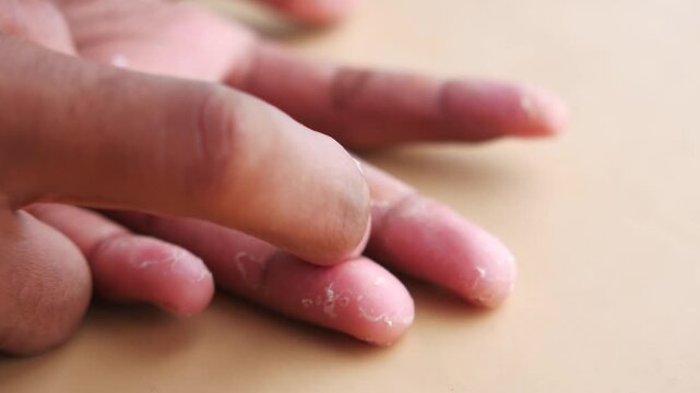 Close up view of skin peeling from fingers due to dry skin condition or disease in slow motion clip