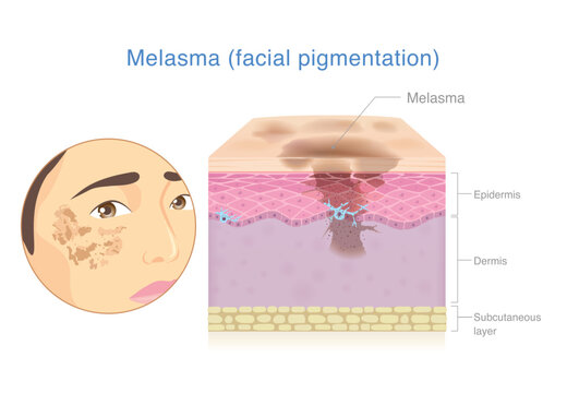 Melasma on woman's facial with anatomy of skin layer that show accumulation of pigment affect to dark spots and hyperpigmentation. Diagram for melasma treatment and skin uneven.