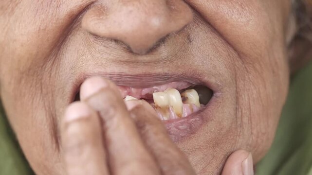Close up view of an old woman showing her teeth with missing and decayed ones a concern for dental health and aging