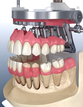 Dental model shows dentures and their articulator device for oral care study
