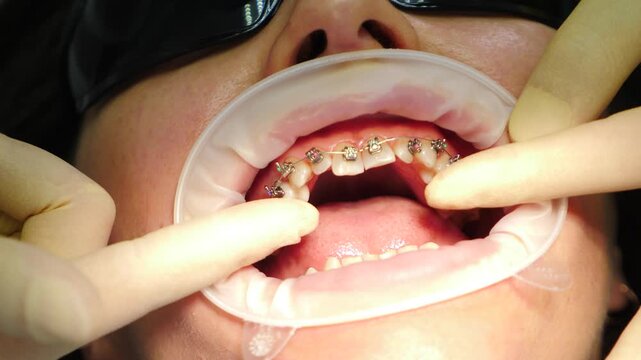Patient with metal dental braces on teeth and dentist showing orthodontic system with her hands. orthodontics, dental care, oral hygiene, and healthy smile. Teeth correction procedure. 4 k video