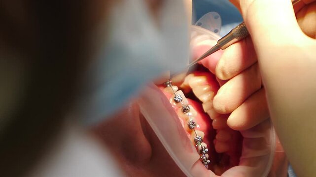 Orthodontist installinf metal bracket system on patient teeth with dental tools. modern dental clinic. Orthodontist Applying Braces, Installation of dental tooth braces. 4 k video