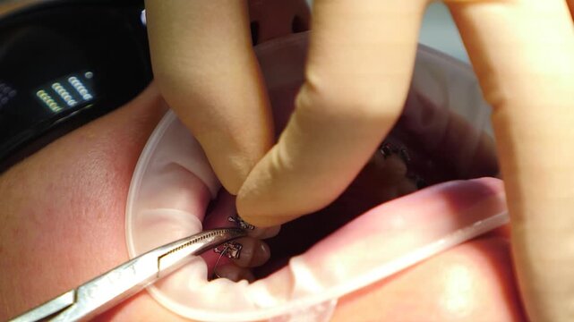 Orthodontist installs arc in ligature braces on patient teeth. Dental treatment for correction of malocclusion. Experient dentist installing bracket system in modern dentistry. 4 k video