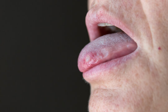 Macro of tongue ulcer showing painful canker sore in mouth
