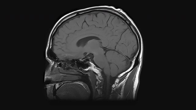 MRI Scan of the Patients Brain. MRI scanning with spatial layer analysis in brain research demonstrates the technology's high effectiveness in detecting abnormalities associated with cognitive disorde