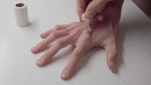 Closeup hand wart removal using dropper, on white table with roll of bandage nearby person applies topical solution to small wart on dorsal hand