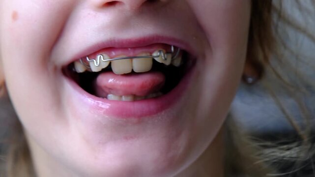 Close-up on girl's teeth, orthodontic plate visible, device for tooth alignment and bite improvement.