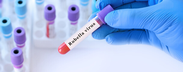 Fototapeta premium Doctor holding blood sample tube with rubella test in clinical laboratory, serological blood analysis for viral infection immunity screening, prenatal diagnostics and preventive healthcare concept