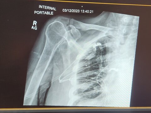 Right shoulder x-ray with normal findings and monitor leads