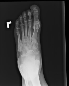 X-ray (projectional radiograph) of the foot of a 64-year-old female, by dorsoplantar projection